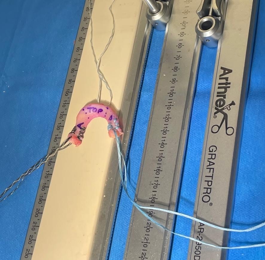 Meniscal allograft prepared and measured on a sizing board with sutures attached before meniscal transplant surgery