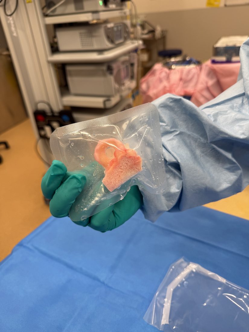 Size-matched meniscal allograft in sterile packaging in the operating theatre before meniscal transplant