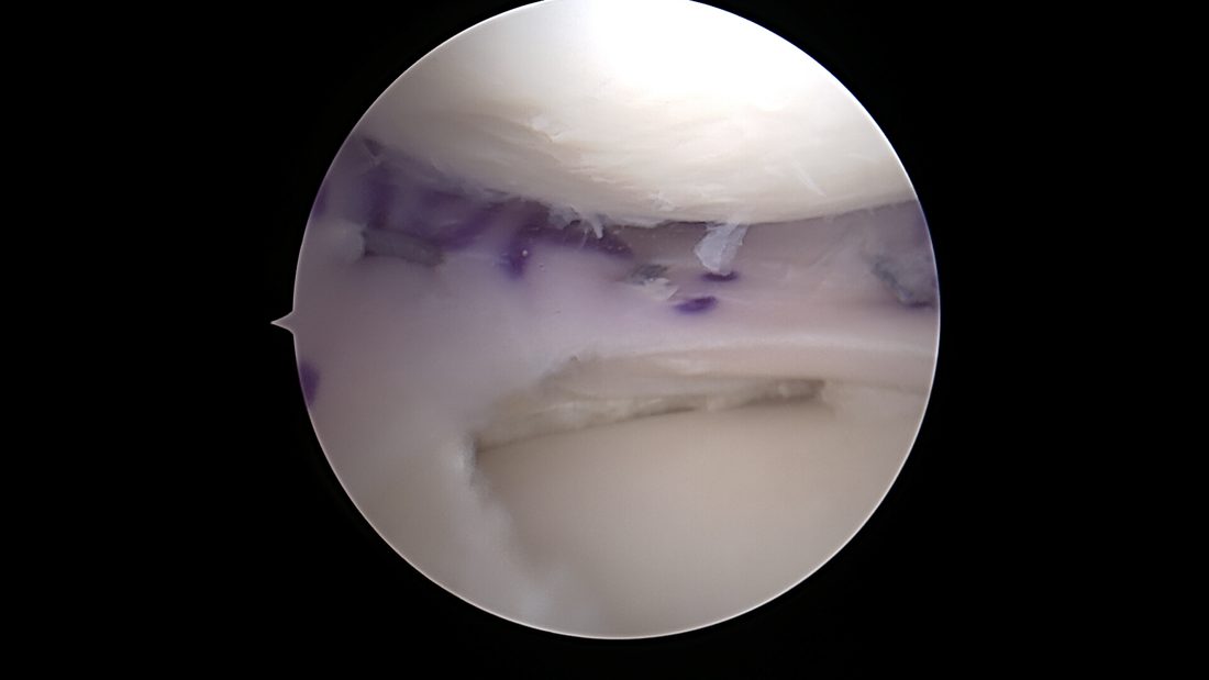 Arthroscopic keyhole view inside the knee joint during meniscal transplant surgery